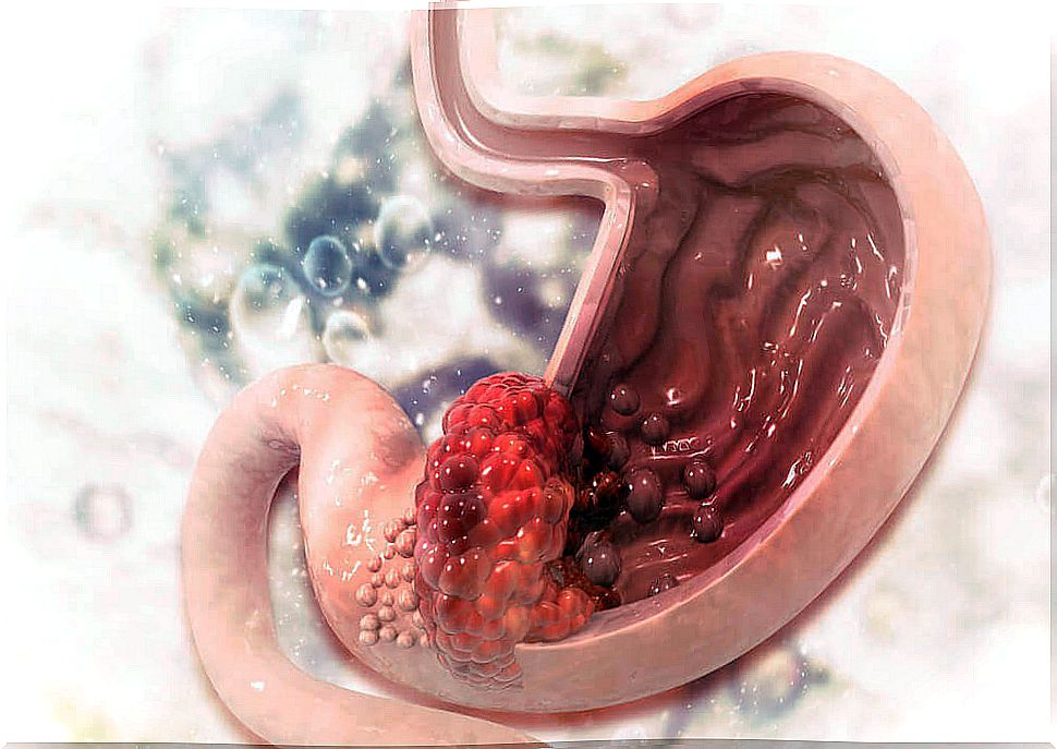 10 symptoms that warn of the existence of a gastroduodenal ulcer