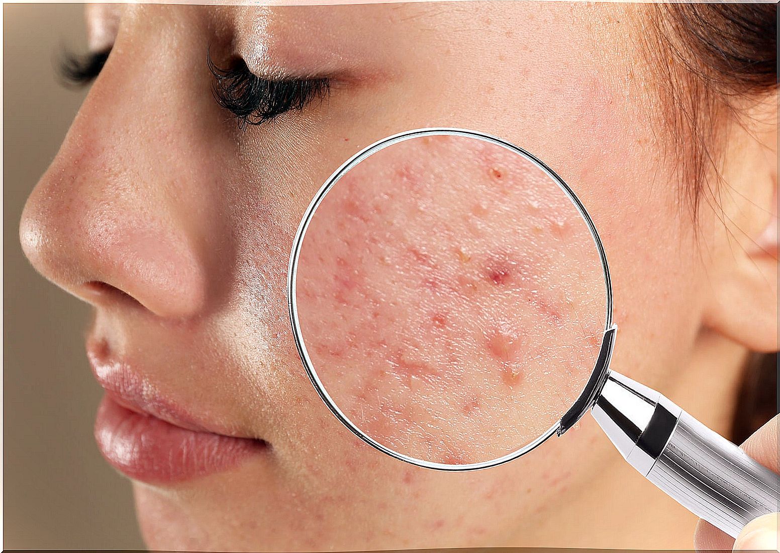 Acne that can be treated with activated charcoal.