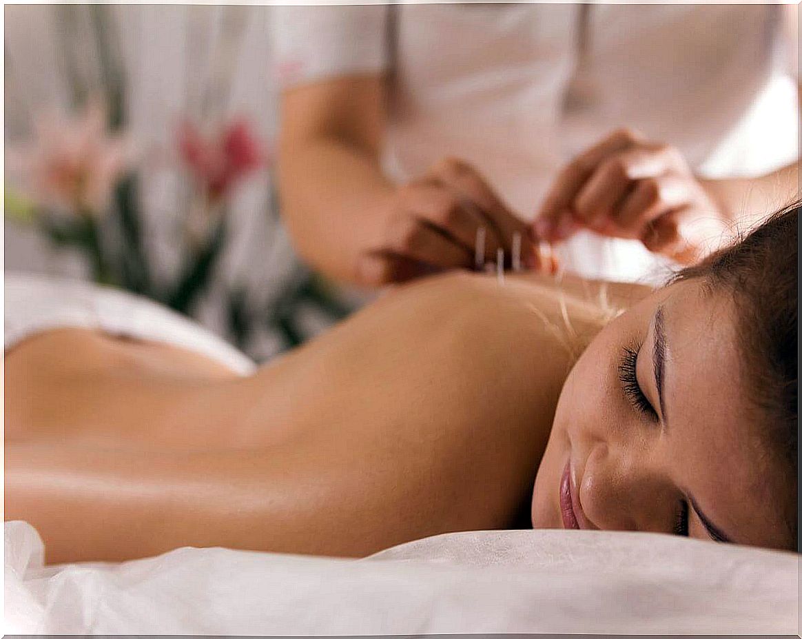 Woman in an acupuncture session