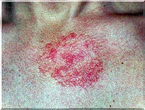 Cosmetic allergy dermatitis