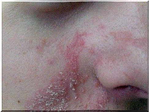 Cosmetic allergy dermatitis