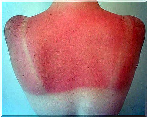 white vinegar for sunburns