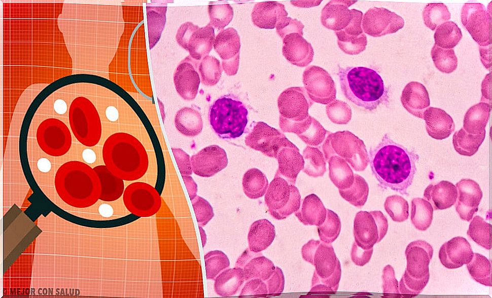 Diagnostic techniques for acute lymphocytic leukemia