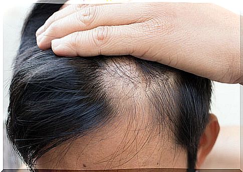 alopecia areata, hair loss