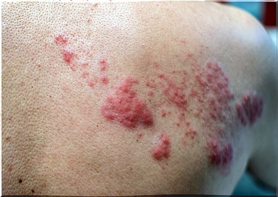 Herpes on the skin as a cause of Behcet's disease.