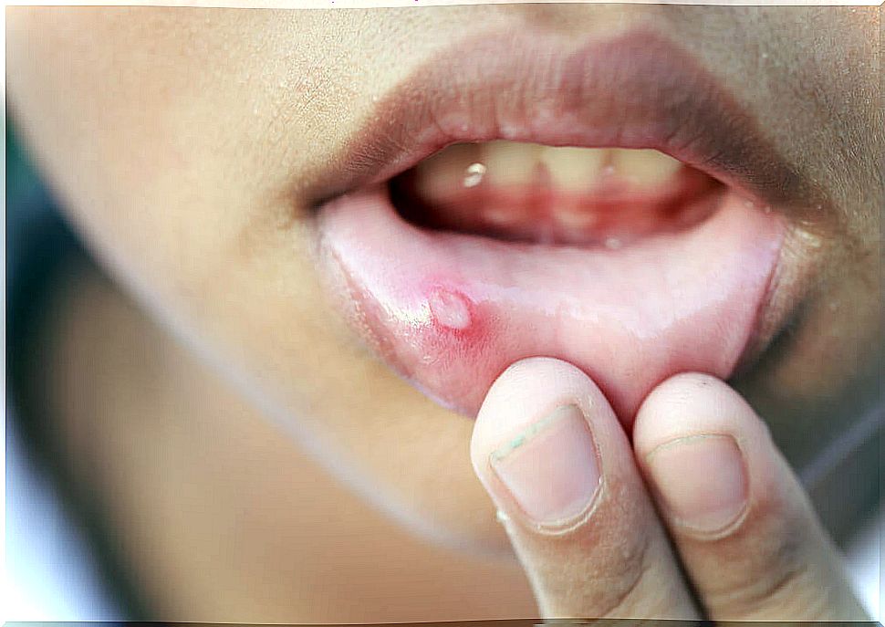 Canker sores due to Behcet's disease.