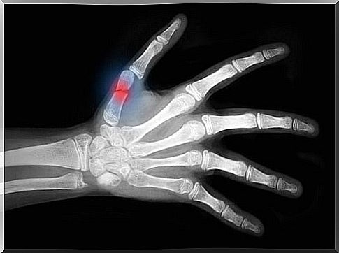 Hand x-ray