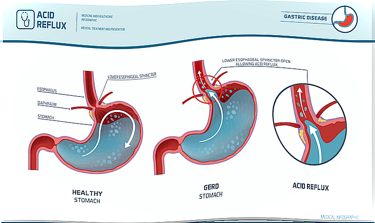 Gastroesophageal reflux scheme