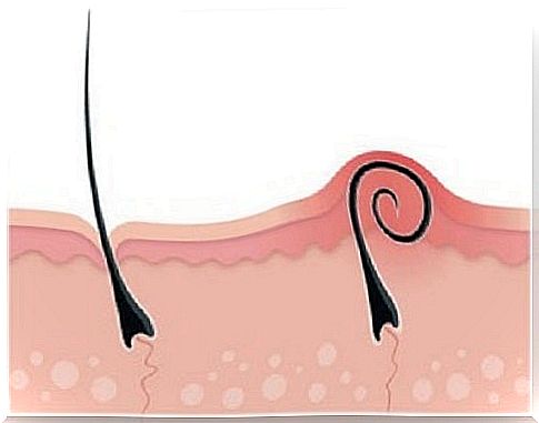 How to say goodbye to ingrown hair