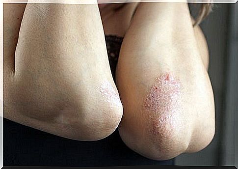 Psoriasis