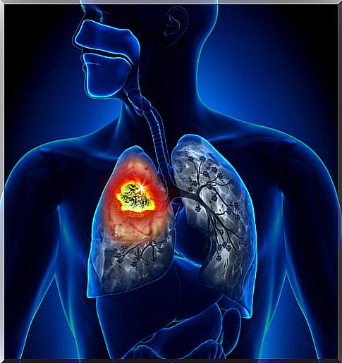 Types of lung cancer