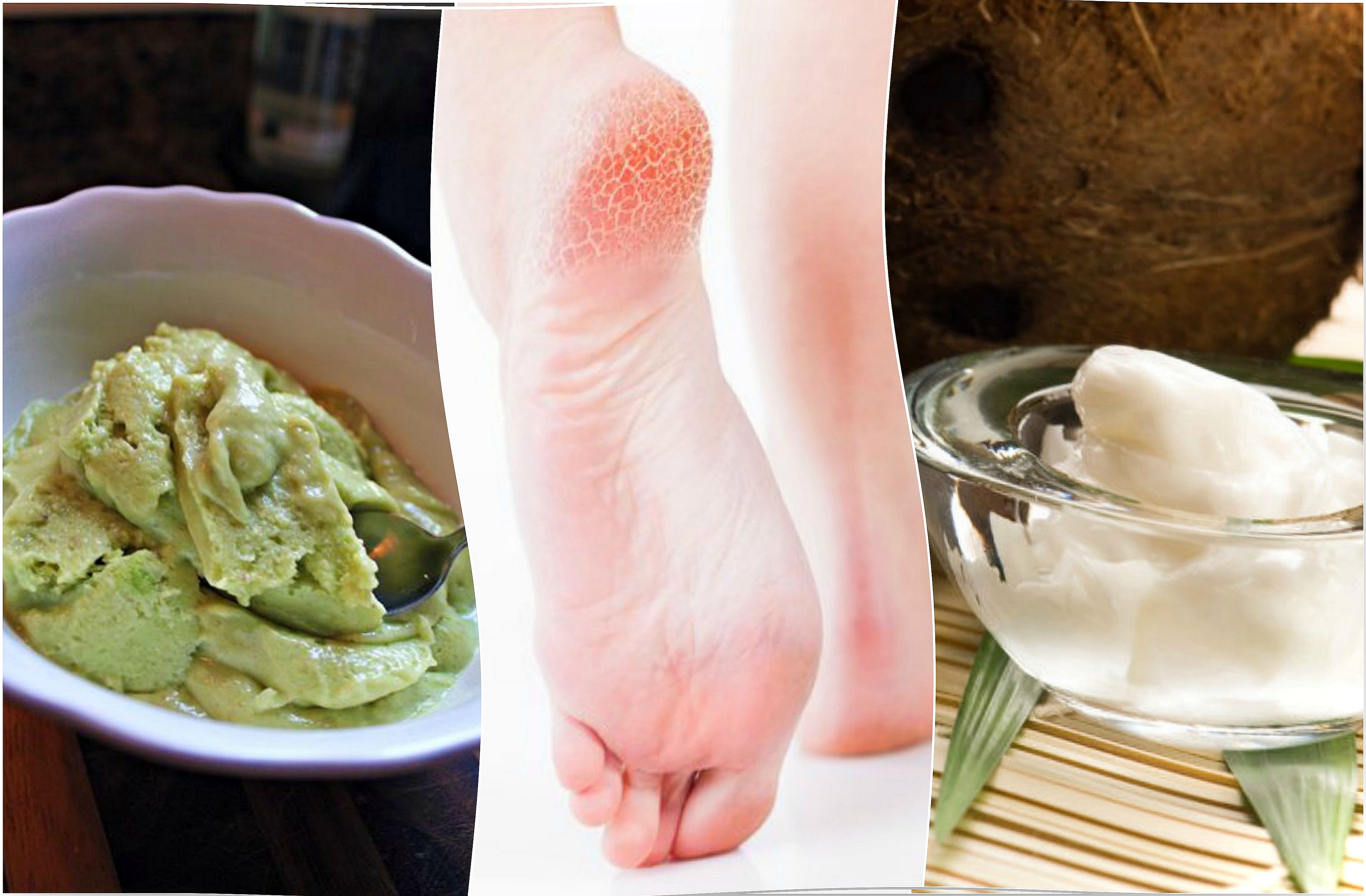 Natural remedies for cracked heels