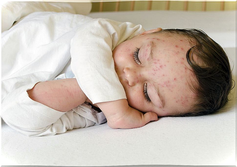 Chickenpox in a child who will later have Ramsay Hunt syndrome.