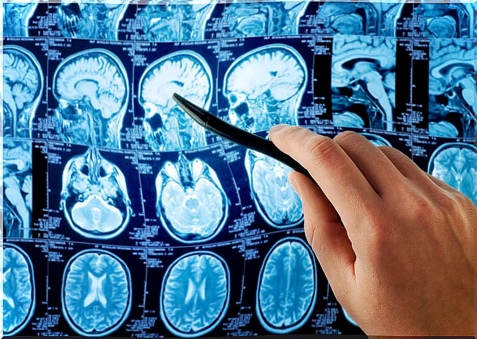 MRI for Ramsay Hunt syndrome.