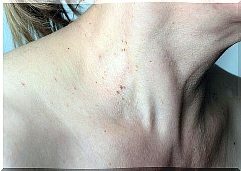 warts in the armpits and neck