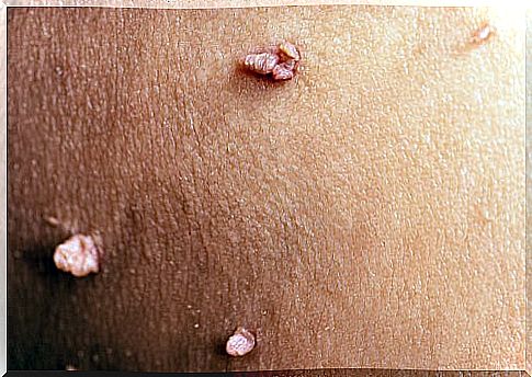 wart on skin