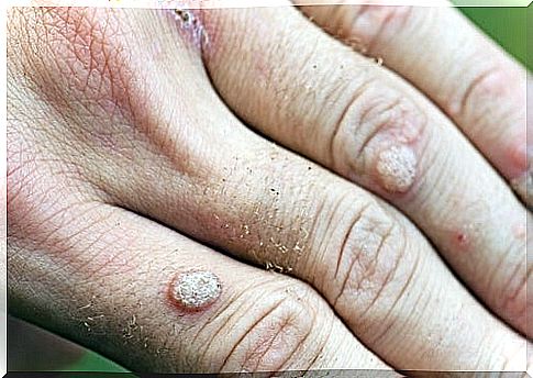 Types of warts and treatments