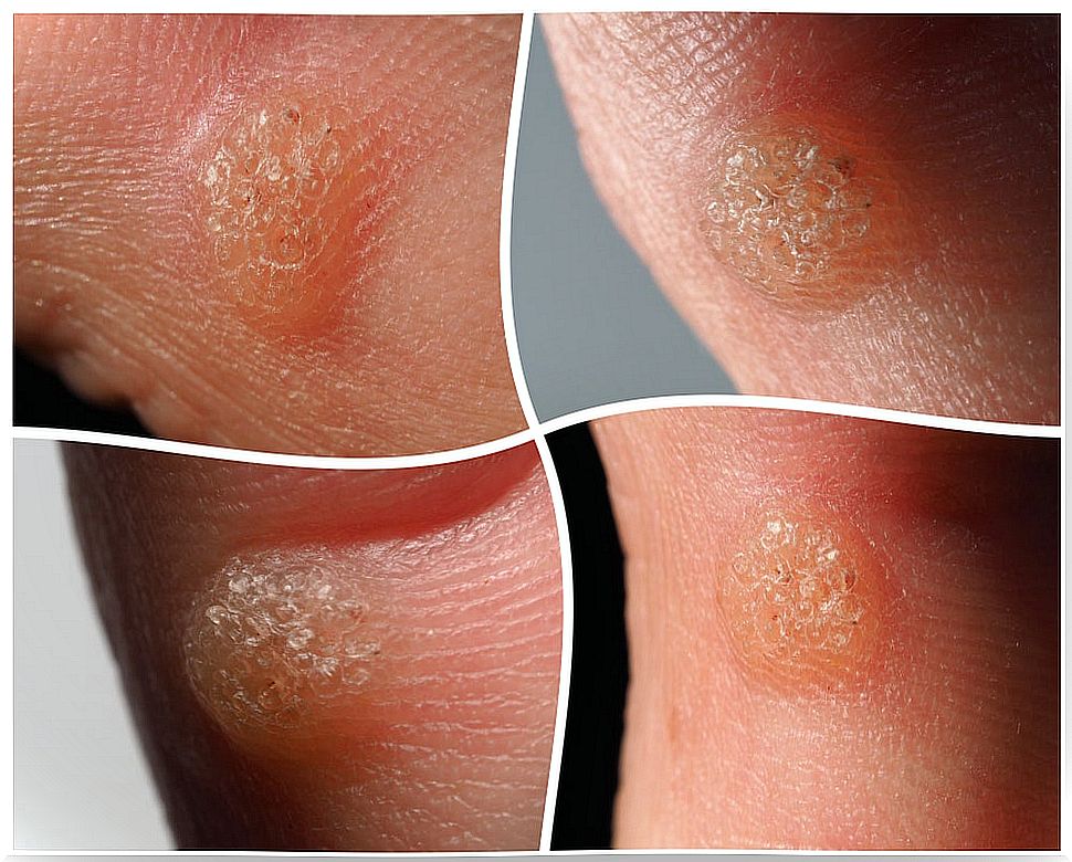 warts on the hands