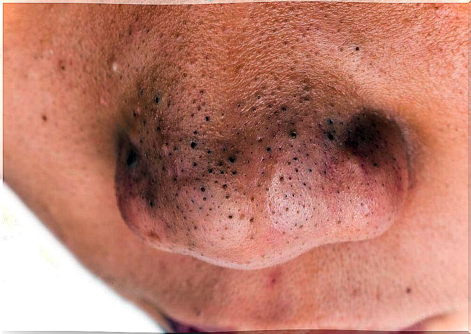 Black spots on the face.